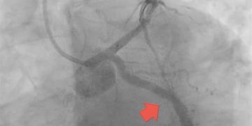 Dr. Țoni Ovidiu: Stentul NU te salvează dacă îți abandonezi tratamentul