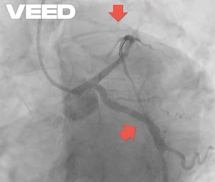 Dr. Țoni Ovidiu: Stentul NU te salvează dacă îți abandonezi tratamentul