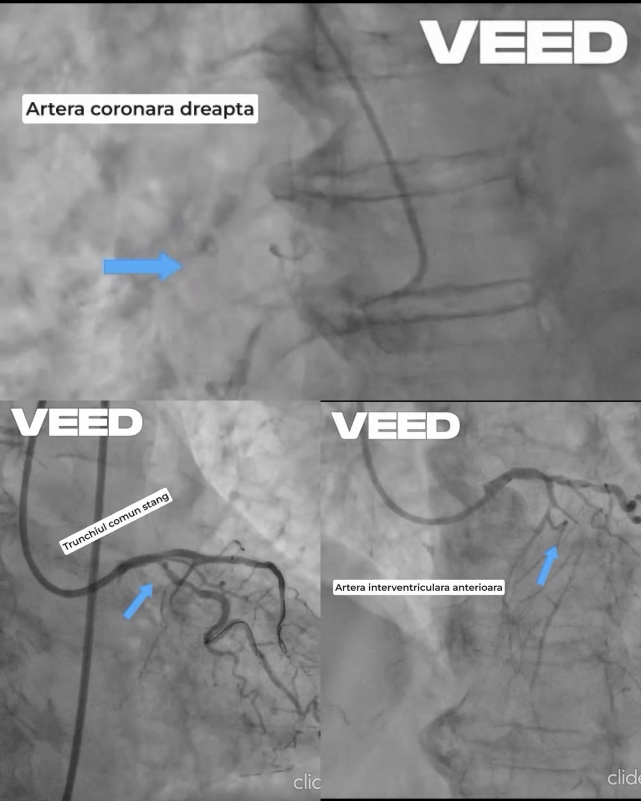 Intervenție spectaculoasă la limită: doctorul Țoni Ovidiu salvează o pacientă de 77 de ani fără operație pe cord deschis!
